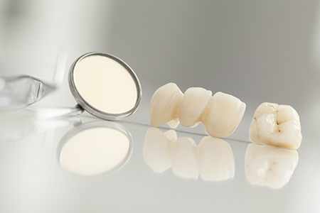 Dental Bridges